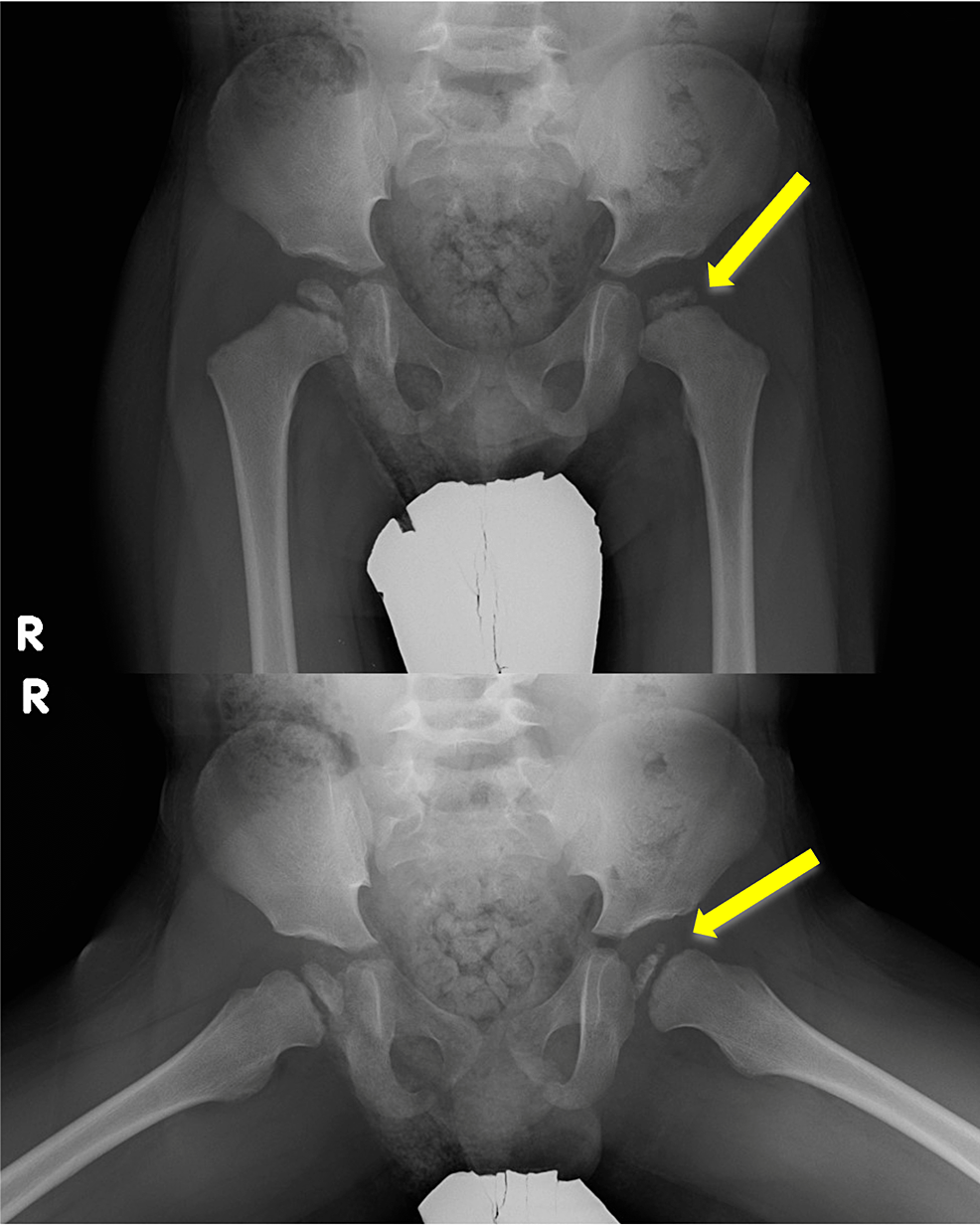 Cureus LeggCalvéPerthes Disease Following Nephrotic Syndrome With