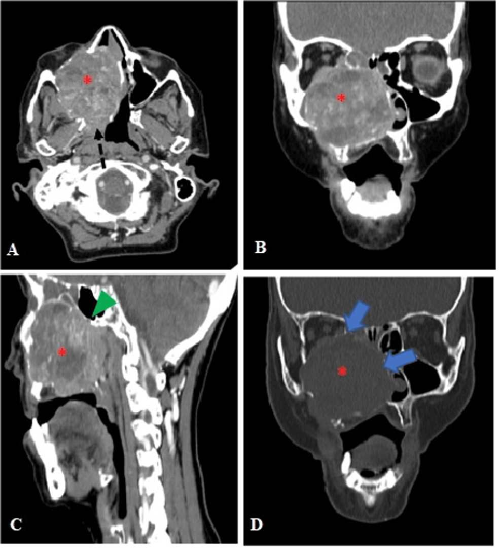 salivary gland cancer research paper