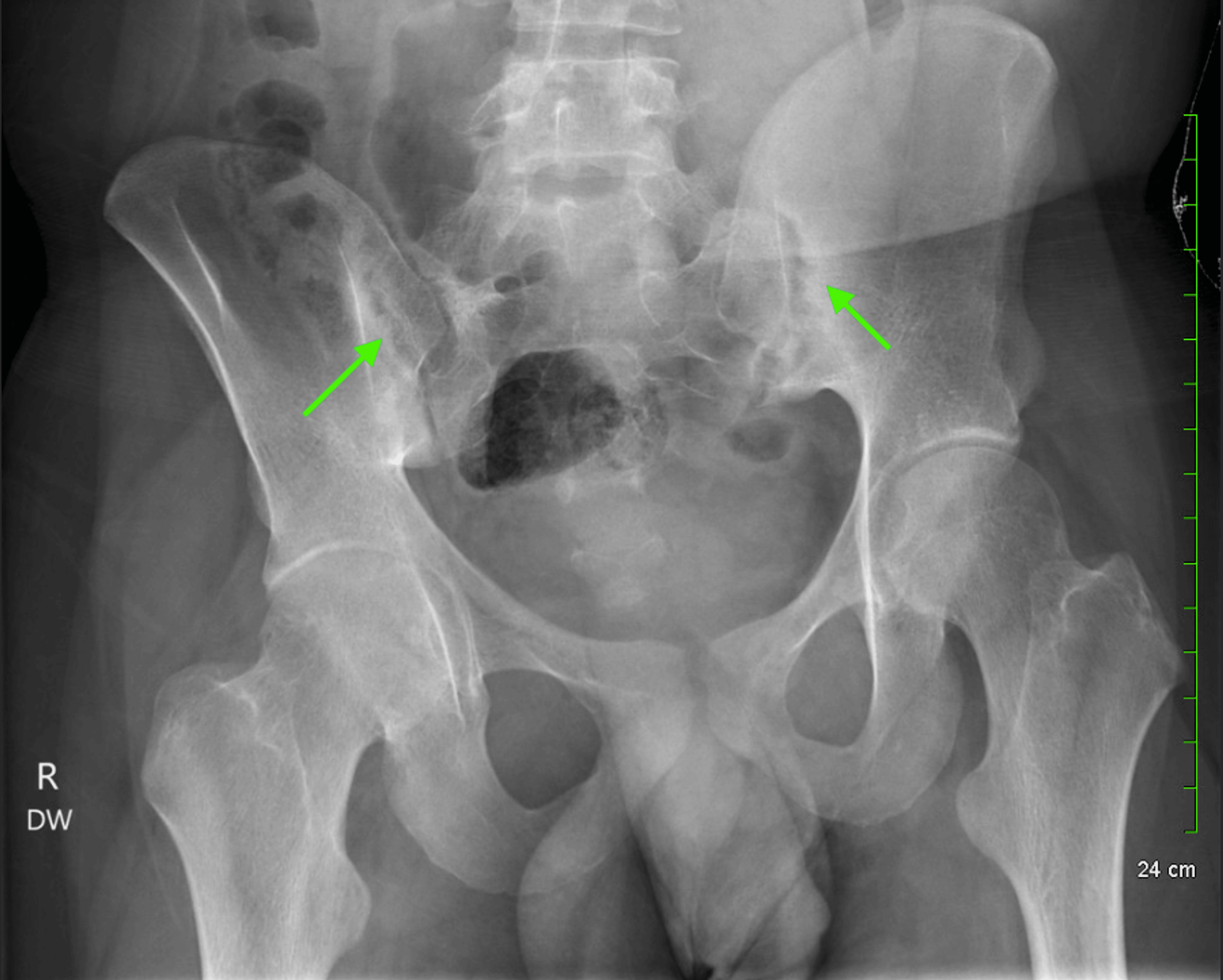 Sacroiliitis Disability Rating 56 - pghezdc