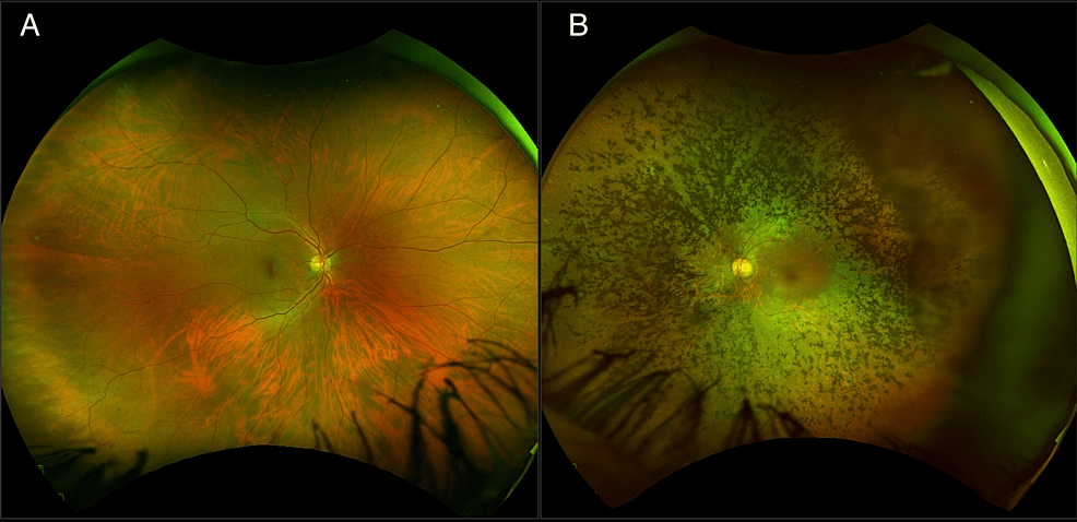 Unilateral Cataract and Retinitis Pigmentosa in a Patient With ...