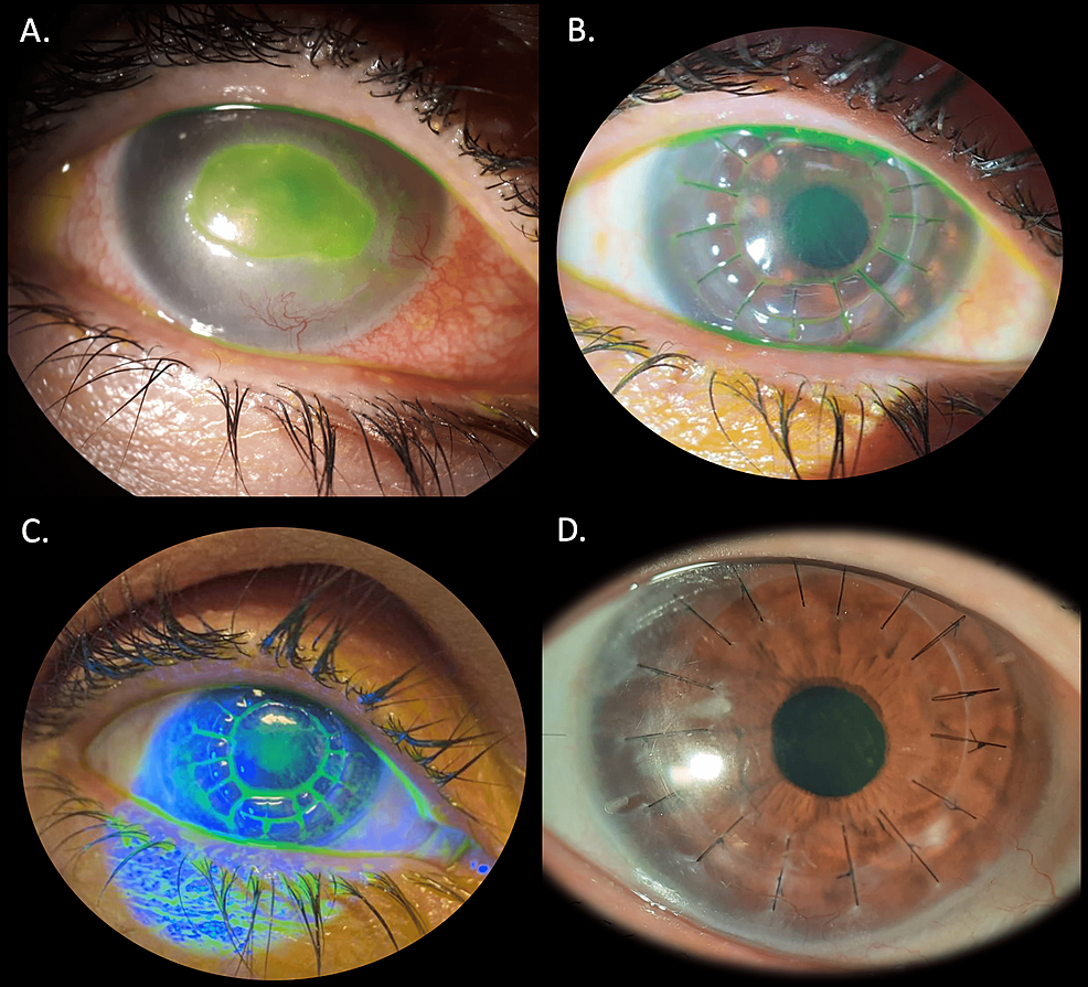 Cureus | New Promising Therapeutic Approach for Refractory Corneal ...