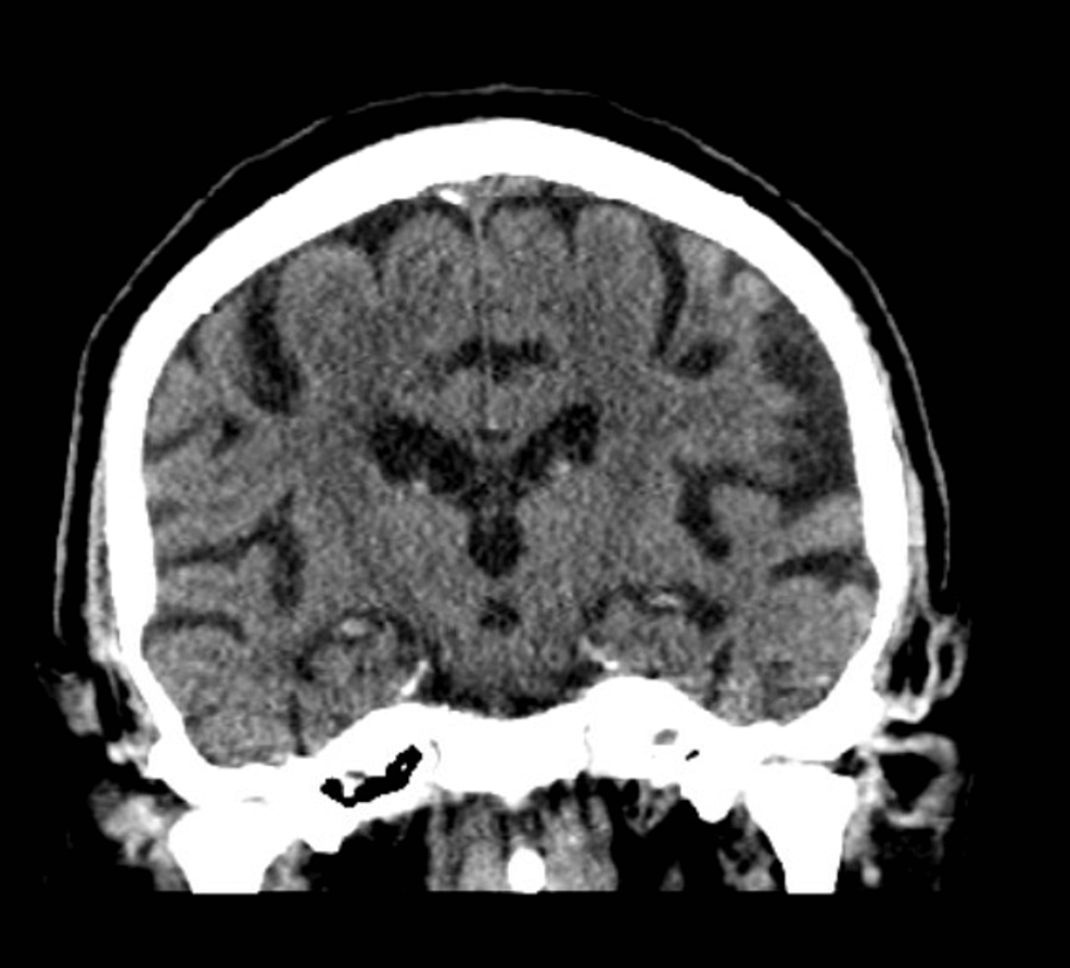 Cureus Combined Presentation of Acute Confusion and Severe