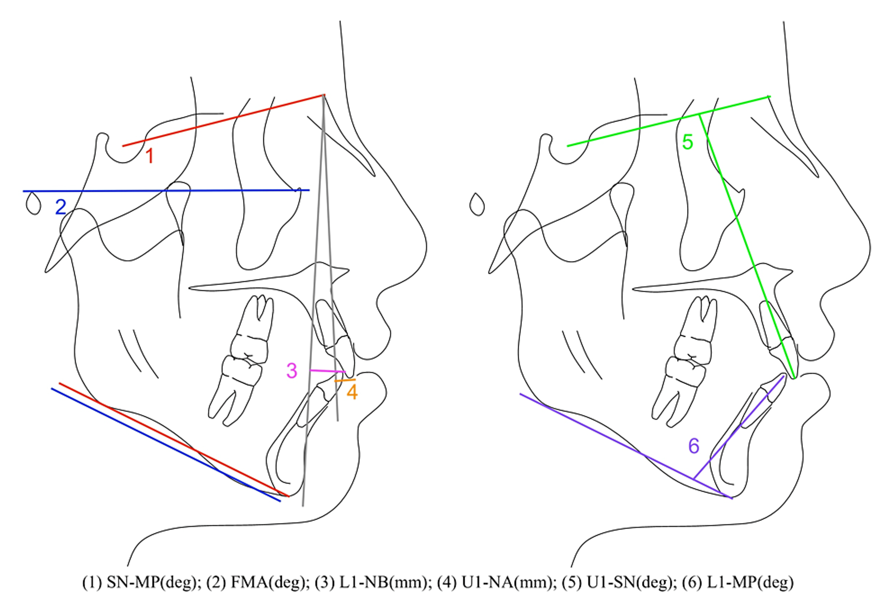 Changes in the Vertical Dimension After Orthodontic Treatment in