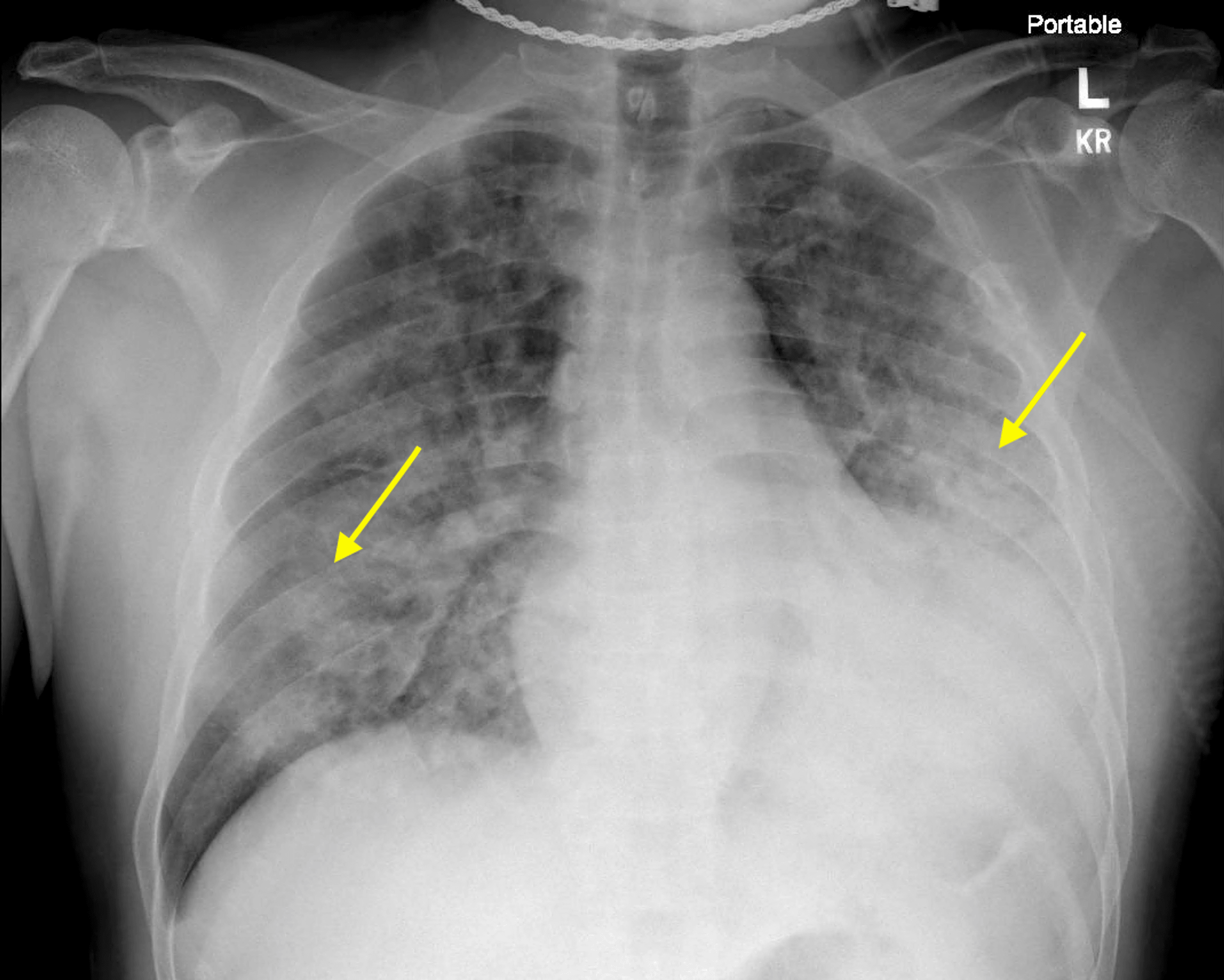 Chest Radiograph Wikipedia 6002