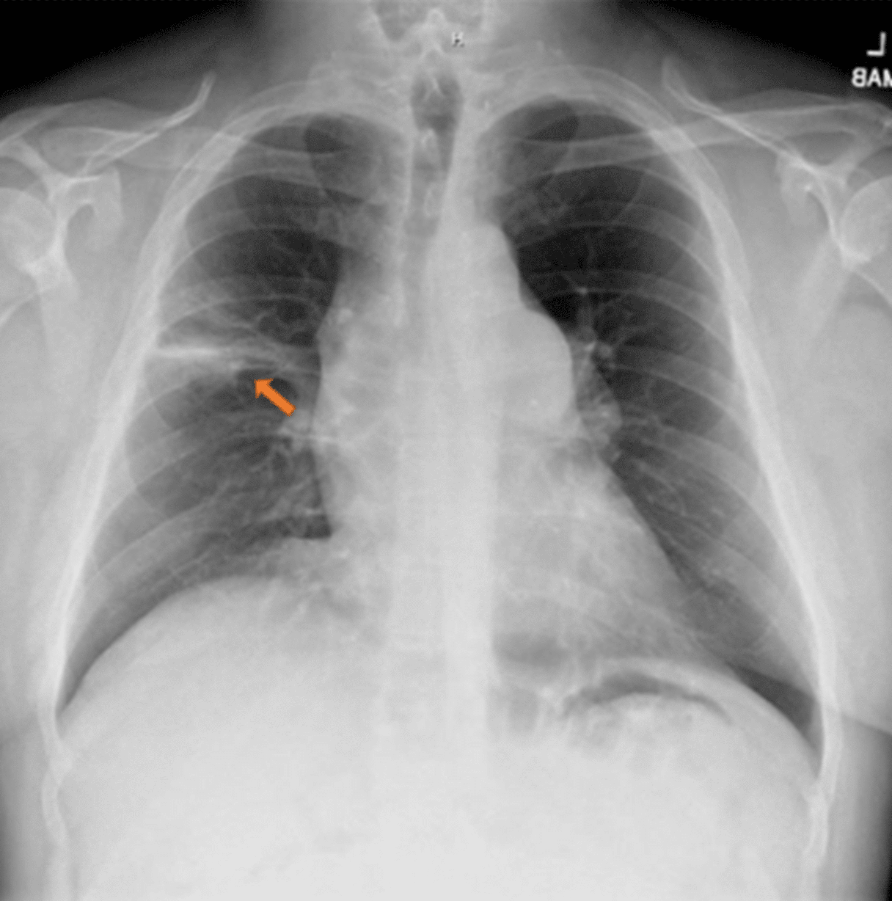 Cureus Necrotizing Pneumonia Secondary to Pulmonary Blastomycosis A