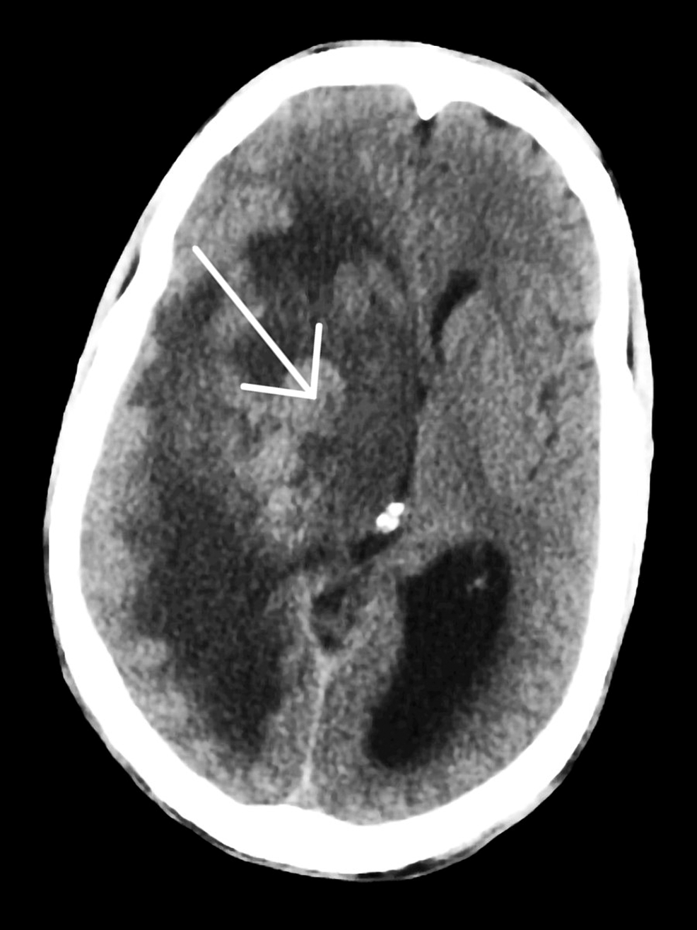 Cureus | Brain Abscess Caused by Nocardia farcinica in a Young ...