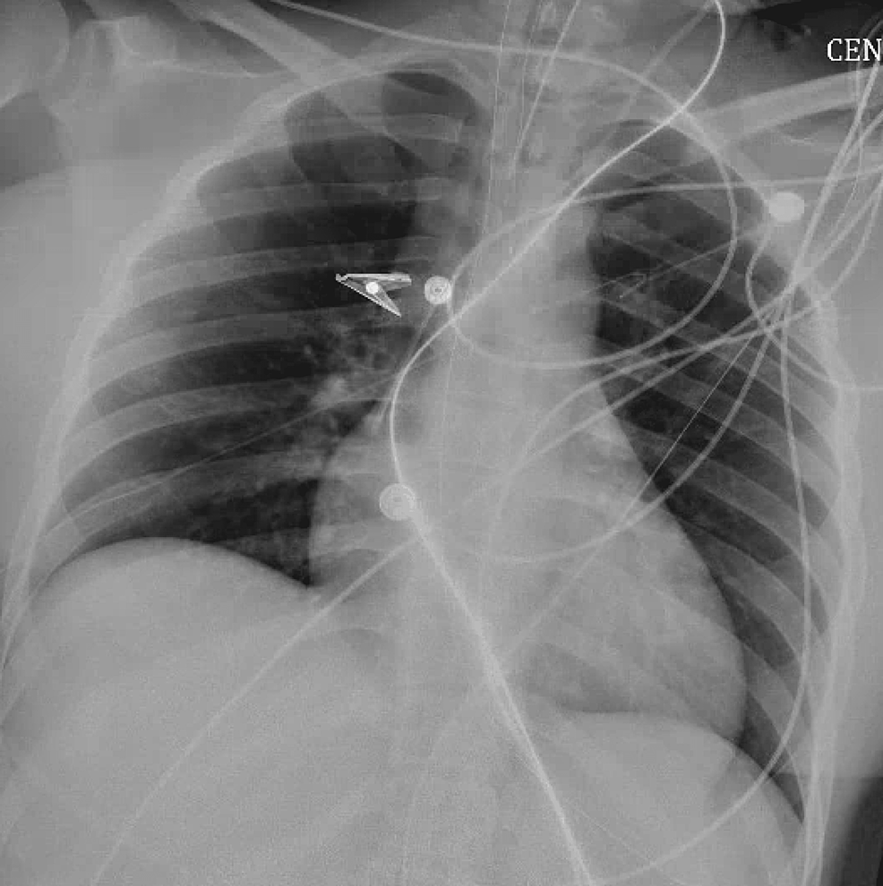 Unusual Presentation and Outcome in Acute Cocaine Intoxication With ...