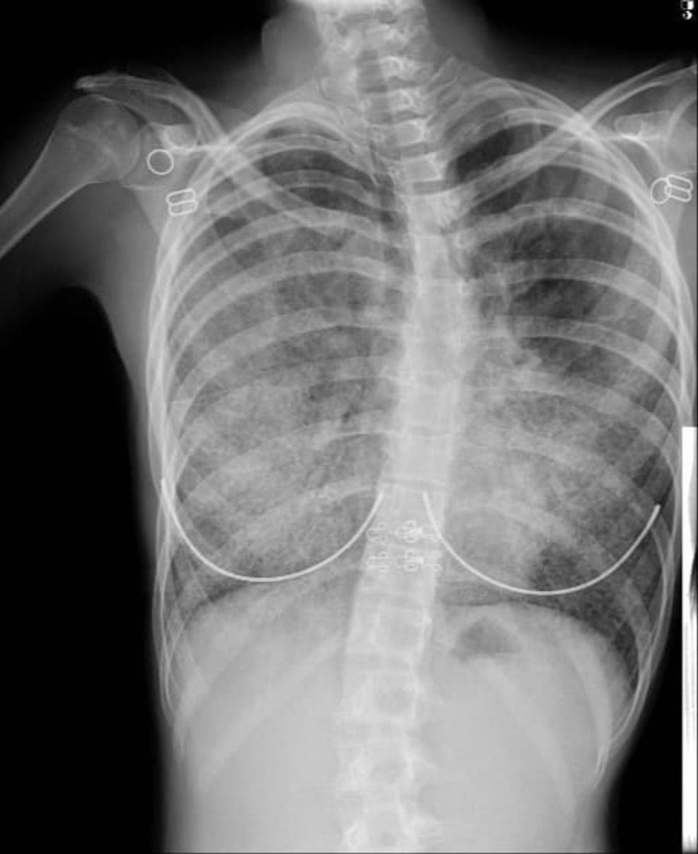 A Case of Pulmonary Alveolar Proteinosis in a 15-Year-Old Female ...