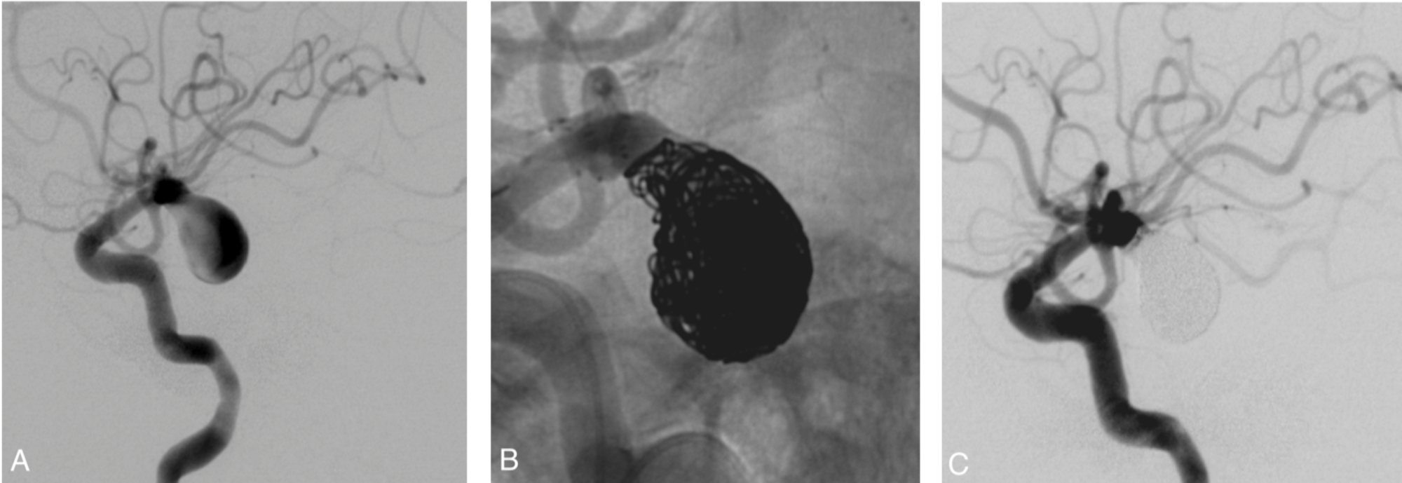 Cureus Safety and Efficacy of Stentassisted Coiling in the Treatment