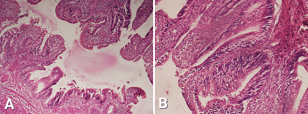 An Uncommon Presentation Of Paraneoplastic Leukemoid Reaction (PLR) In ...