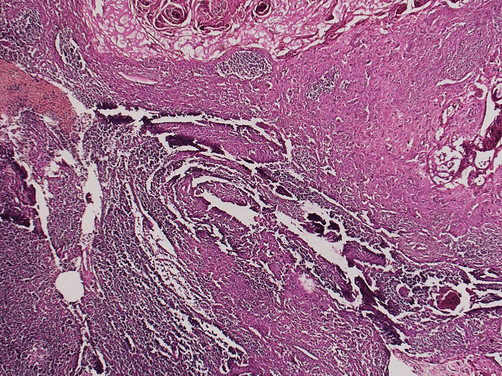 An Uncommon Presentation Of Paraneoplastic Leukemoid Reaction (PLR) In ...