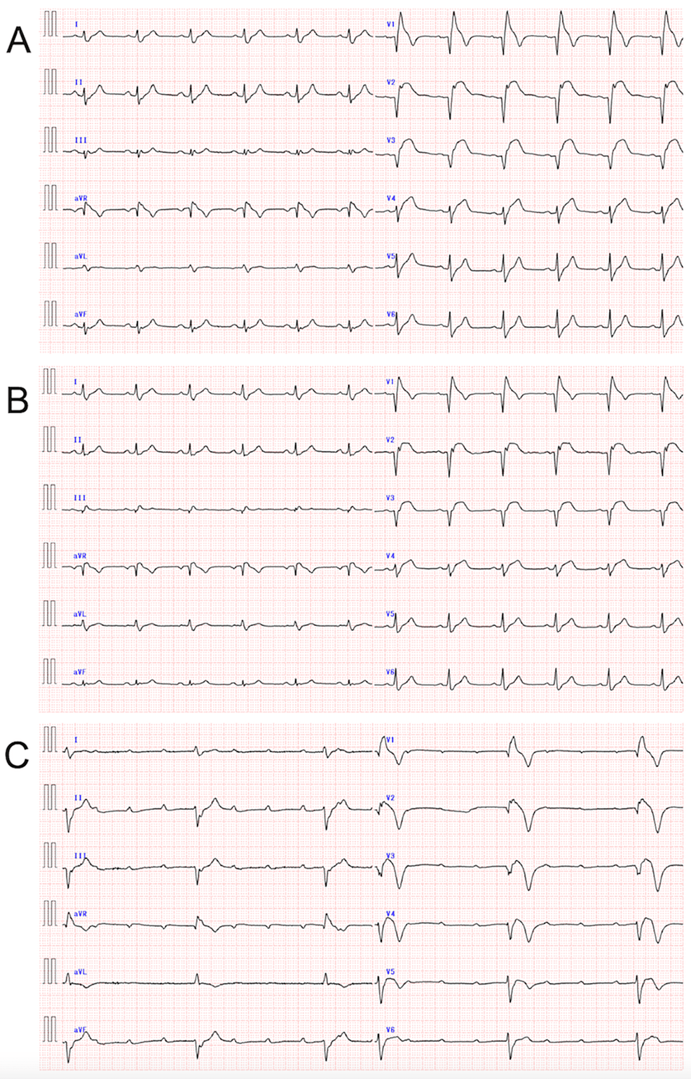 Cureus Vasospasm in the First Septal Perforator Branch and Late High