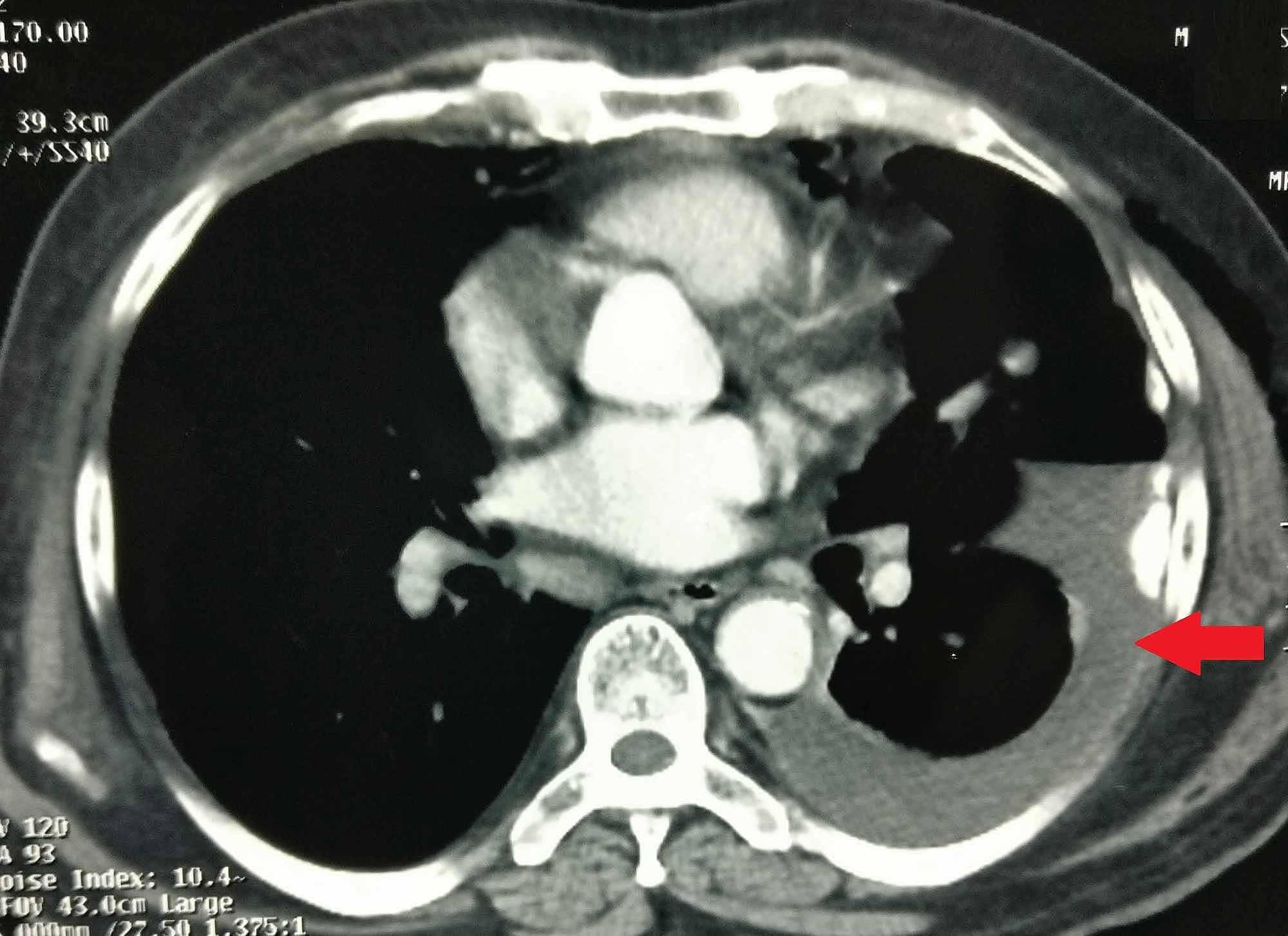 is sarcomatoid carcinoma curable