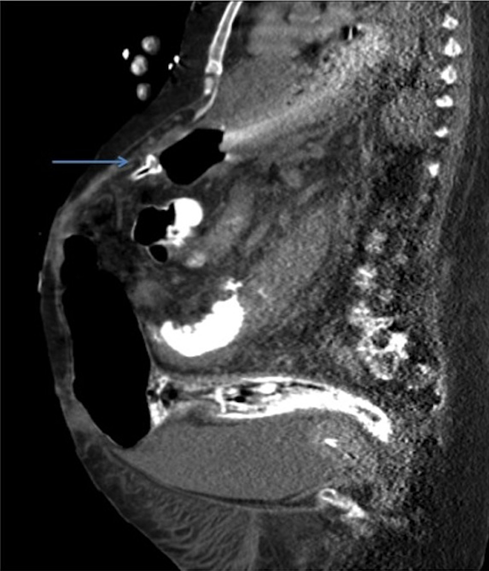 Cureus The Buried Bumper Syndrome A Catastrophic Complication of