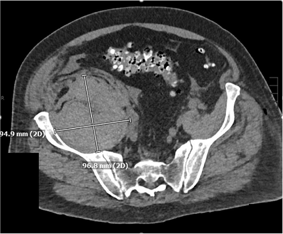 cureus-spontaneous-retroperitoneal-hematoma-after-total-hip-arthroplasty