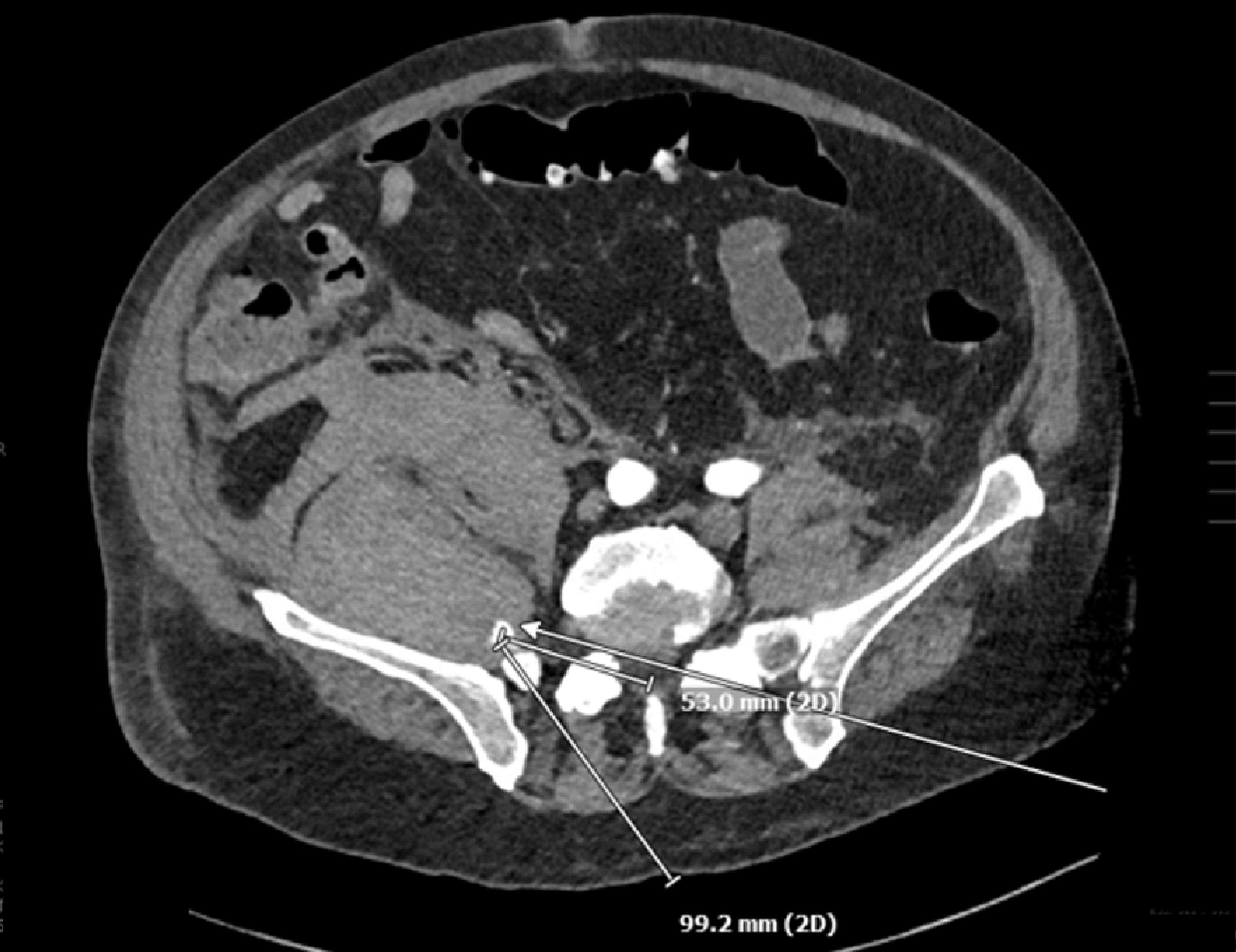 Spontaneous Retroperitoneal Hematoma After Total Hip Arthroplasty Cureus