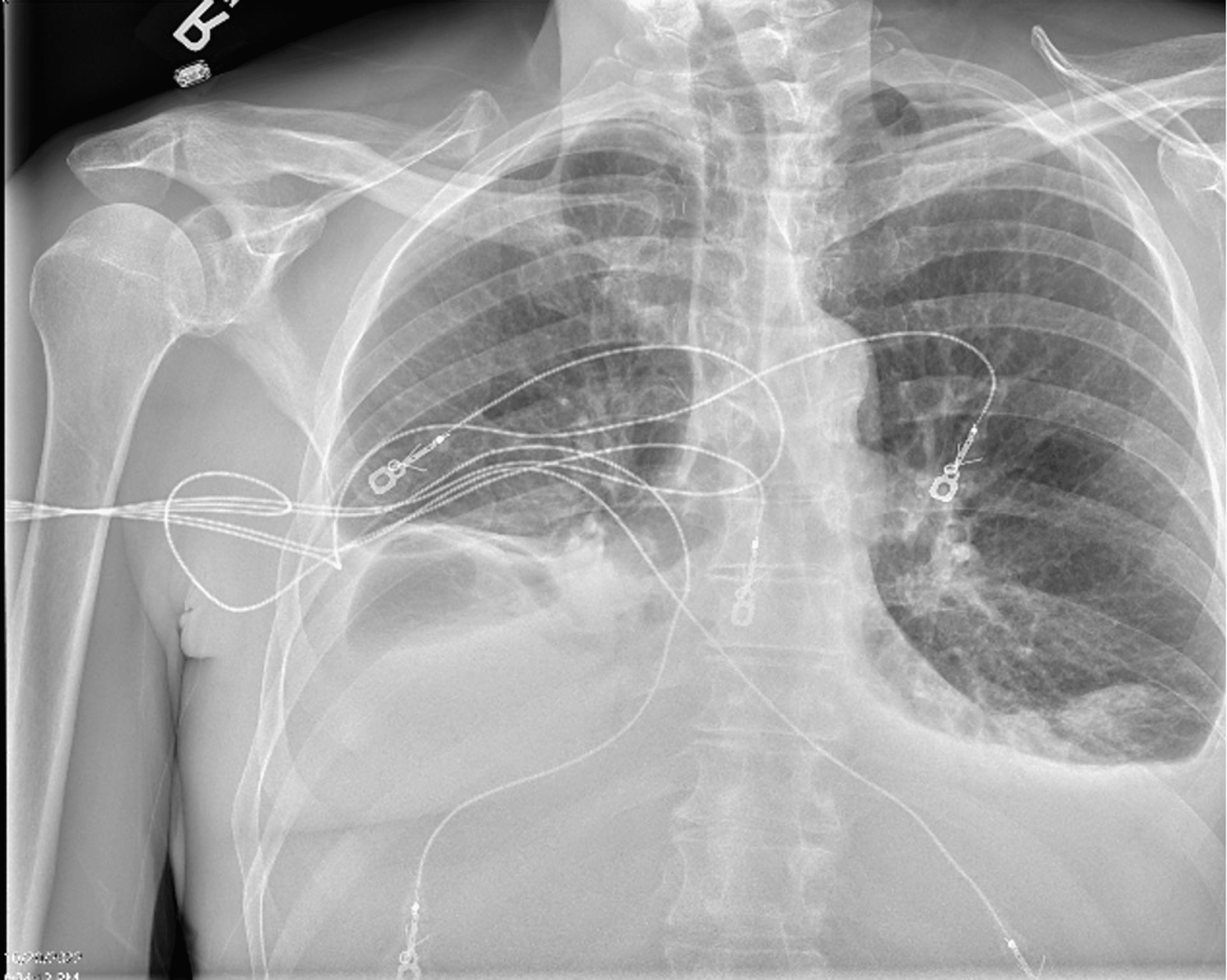 Paradoxical Left Ventricular Hypertrophy By Echocardiogram And Low ...