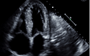 Paradoxical Left Ventricular Hypertrophy By Echocardiogram And Low ...