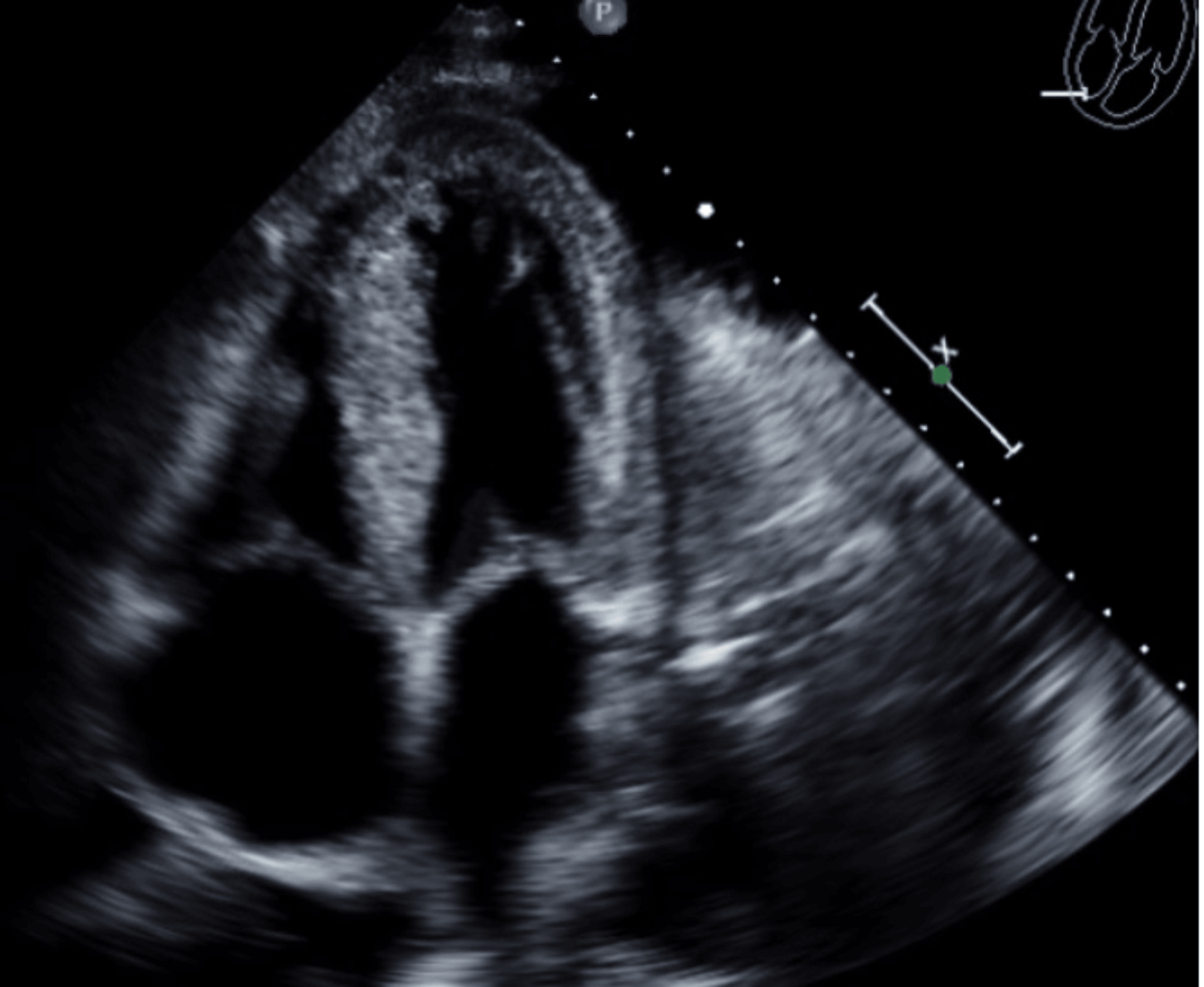 Paradoxical Left Ventricular Hypertrophy By Echocardiogram And Low ...