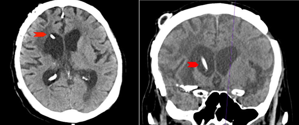 Ventriculoperitoneal Shunt Migration Inside the Gastric Lumen: A Rare ...