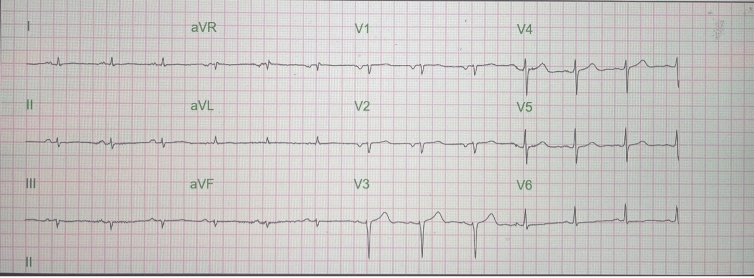 Paradoxical Left Ventricular Hypertrophy By Echocardiogram And Low ...