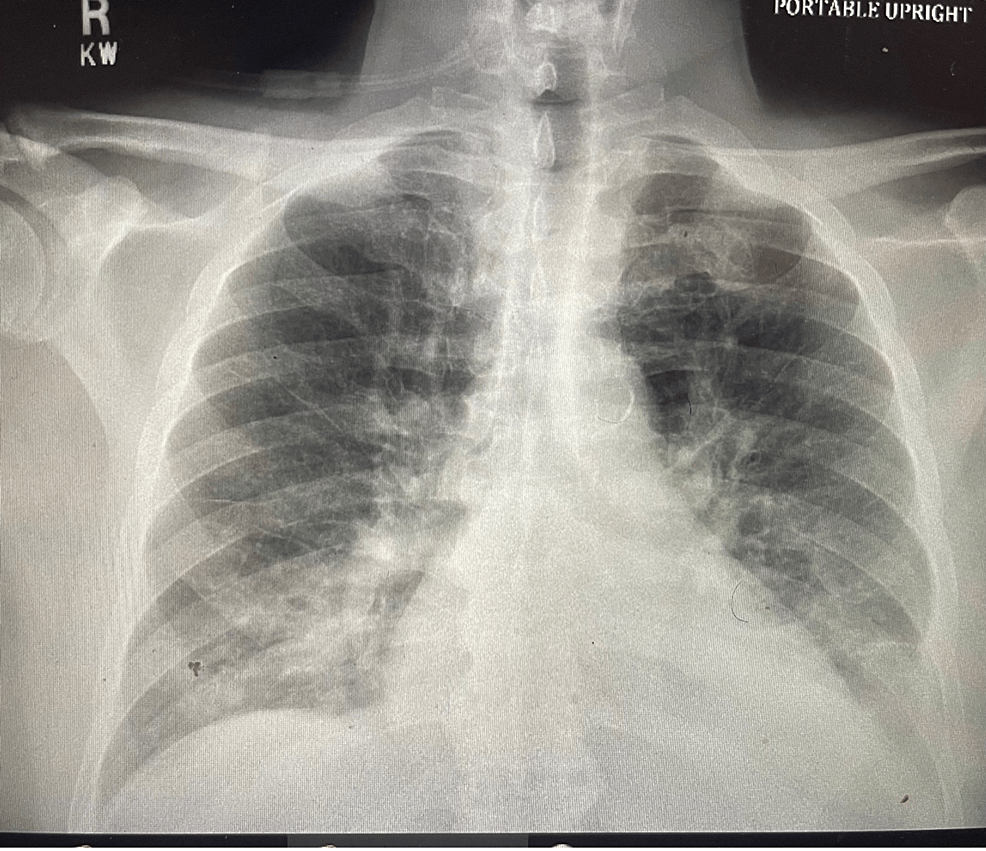 Paradoxical Left Ventricular Hypertrophy By Echocardiogram And Low ...