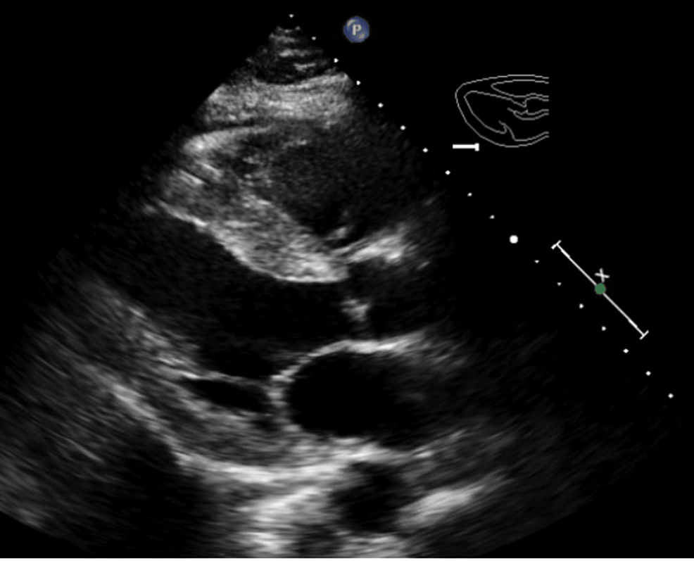 Paradoxical Left Ventricular Hypertrophy By Echocardiogram And Low ...