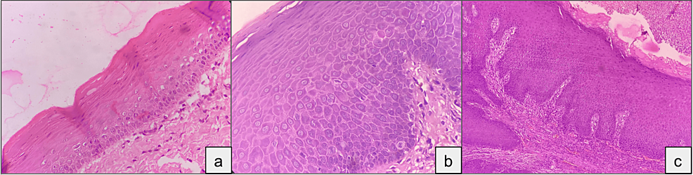 Ki 67 Expression As A Prognostic Marker A Comparative Immunohistochemical Analysis Of Oral 0254