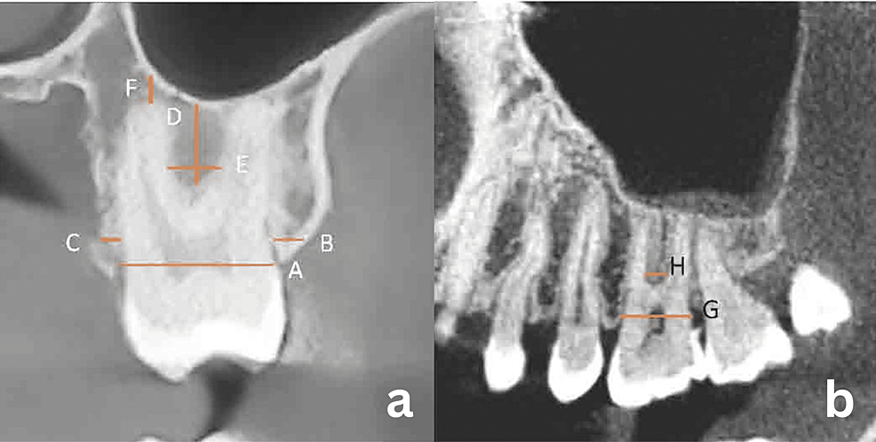 cureus-cone-beam-computed-tomography-cbct-based-assessment-of-the