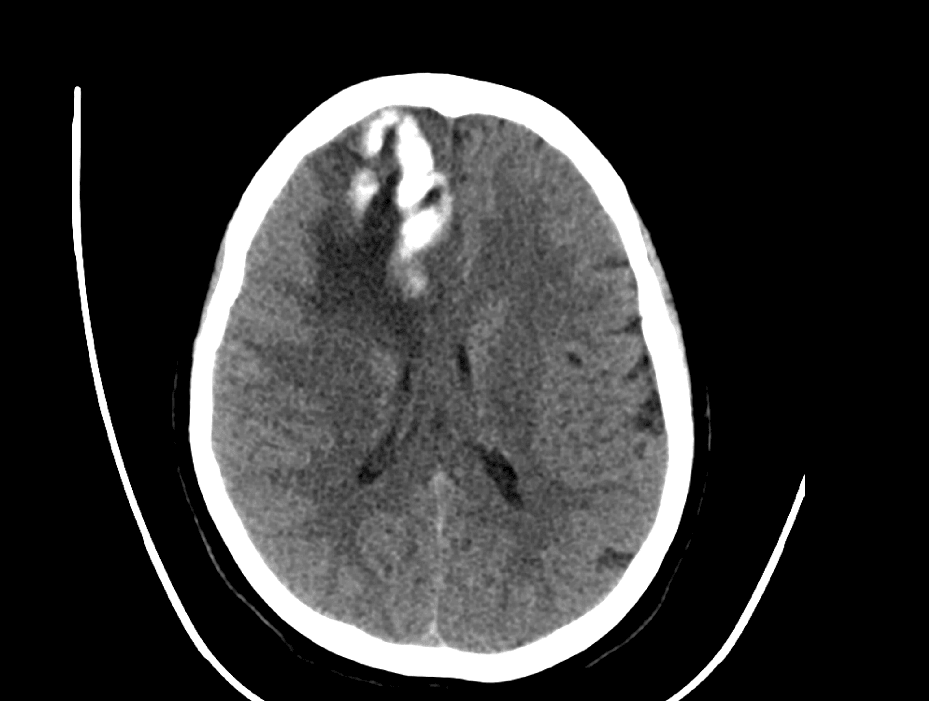 Cureus | Remote Cerebellar Hematoma Following Supratentorial Craniotomy ...