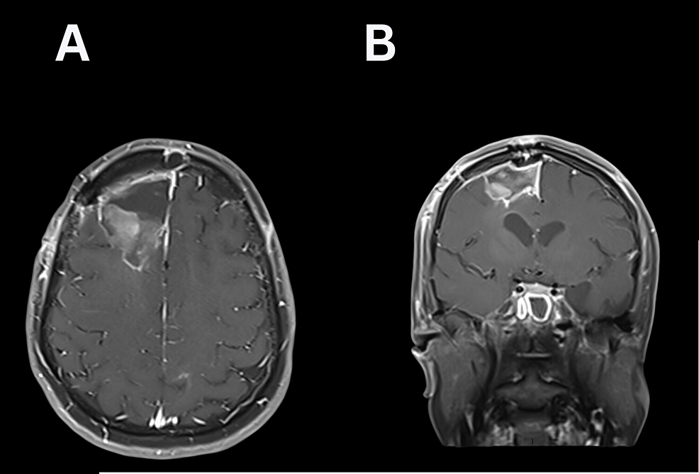 Cureus | Remote Cerebellar Hematoma Following Supratentorial Craniotomy ...