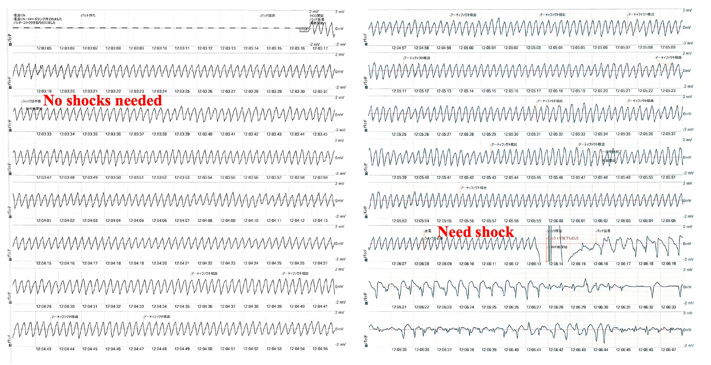 Recognition of Pulseless Ventricular Tachycardia Through the Second Analysis of Automated