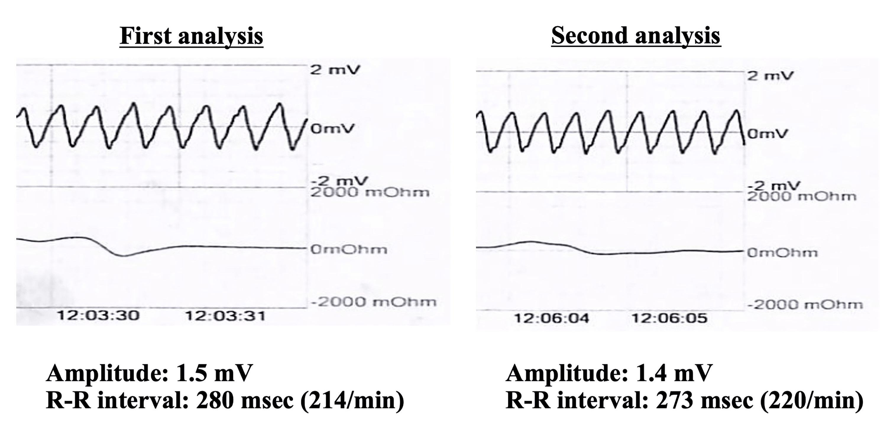 Recognition of Pulseless Ventricular Tachycardia Through the Second Analysis of Automated
