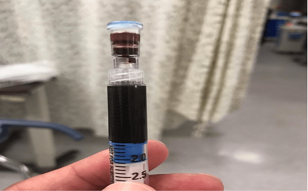 glutathione iv malaysia In Malaysia, IV glutathione is not officially recognised by KKM for skin  whitening, and as medical doctors, we must respect the current guidelines.  However, globally, IV wellness drips (including antioxidants, vitamins, and