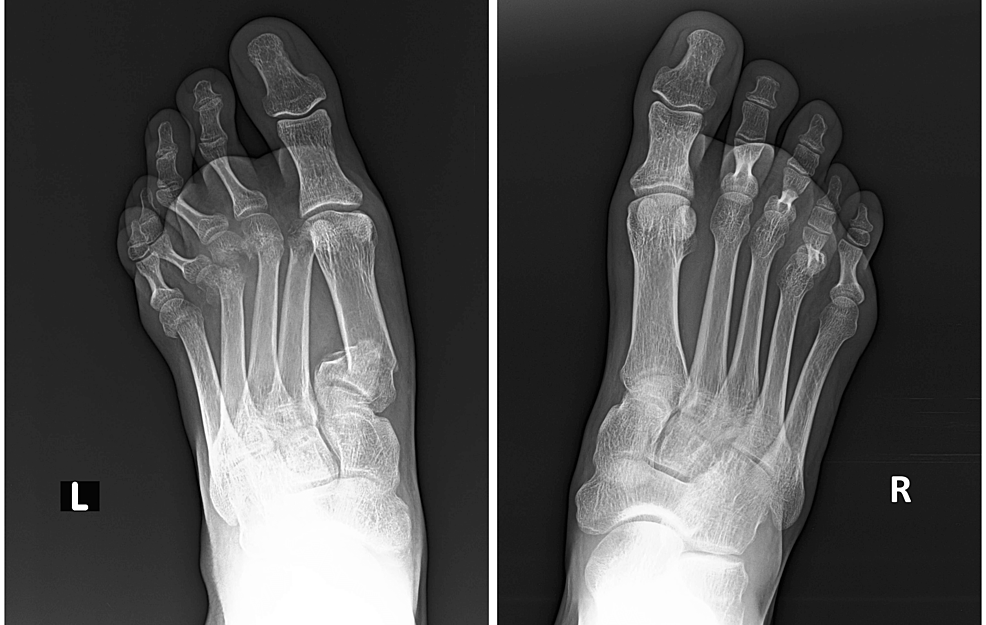 Cureus Match The Metatarsal Heads A Case Of All Metatarsal Fractures After A Motorcycle Accident