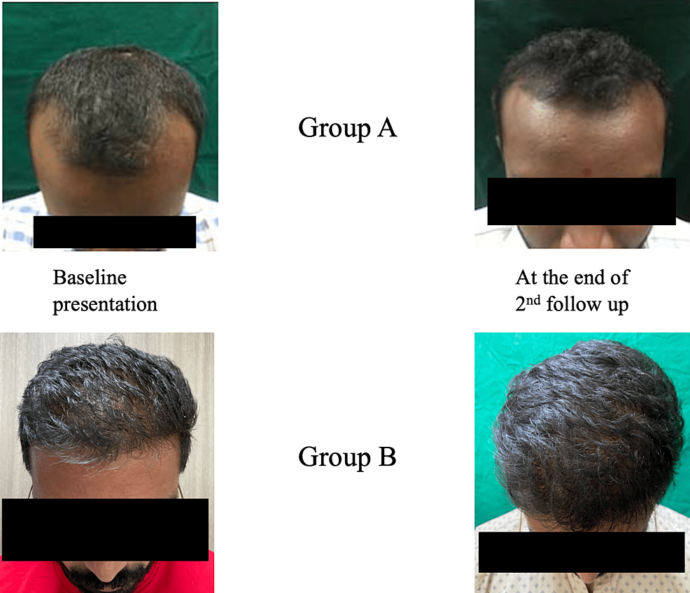 Topical Saw Palmetto Oil - Prevent Hair Loss, Restore Hair Growth –  HAIRMETTO