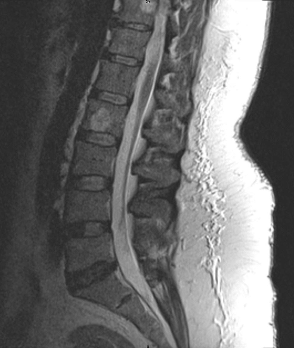 Cureus Lumbar Facet Joint Fluid A Reliable Sign of Lumbar Instability