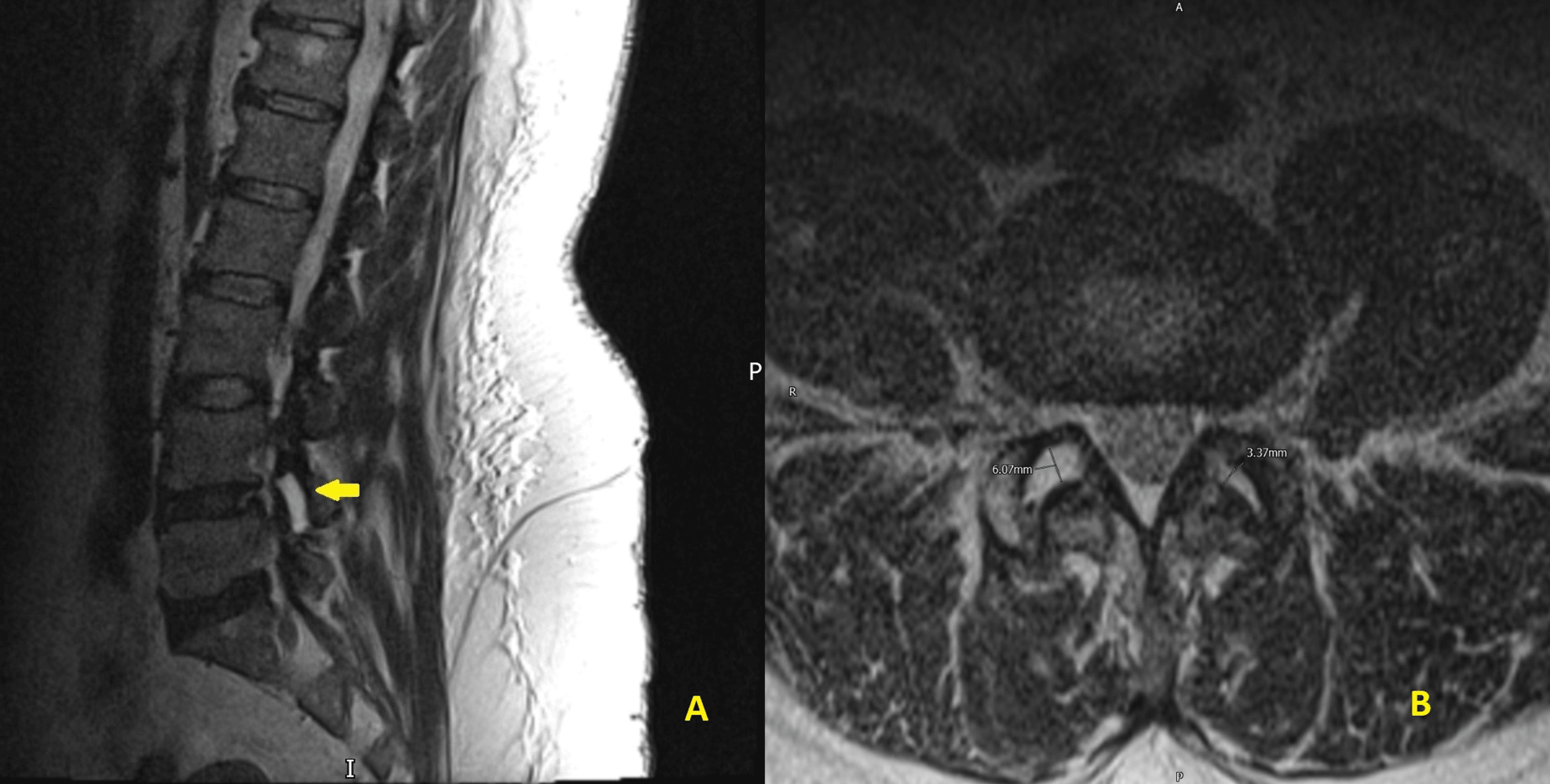 Cureus Lumbar Facet Joint Fluid A Reliable Sign of Lumbar Instability
