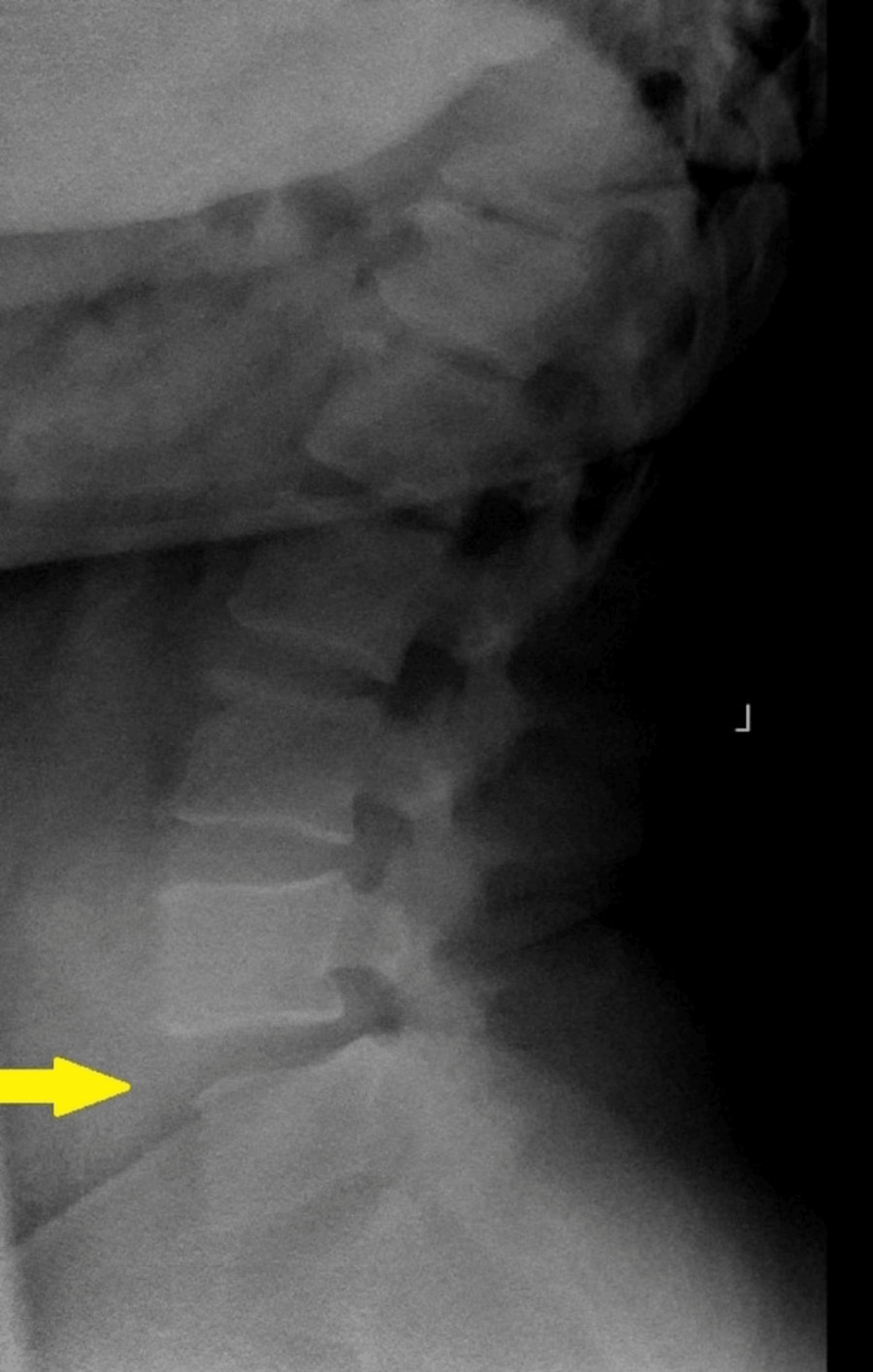 Lumbar Facet Joint Fluid A Reliable Sign of Lumbar Instability Cureus