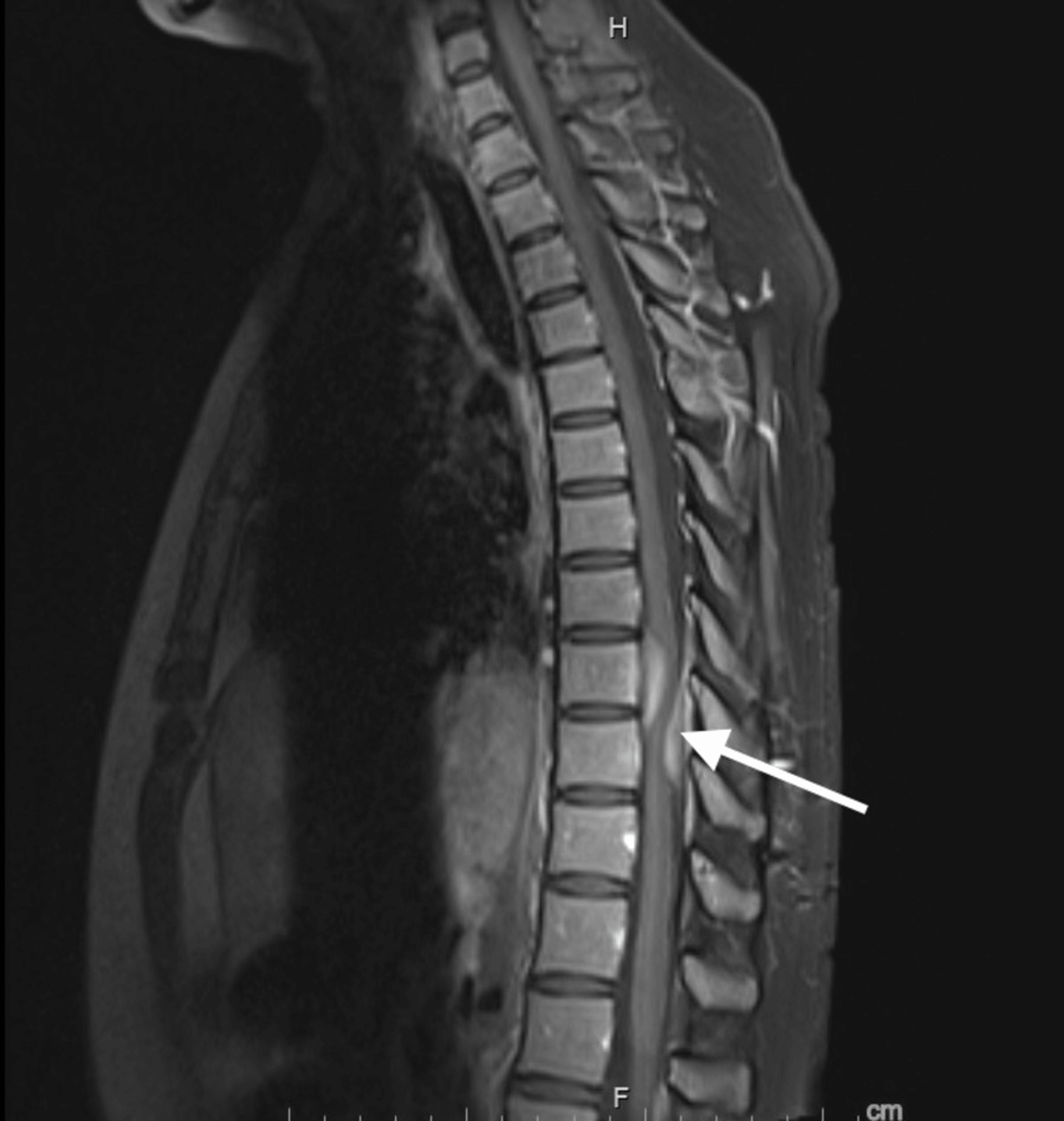 Cureus Spinal Hypertrophic Pachymeningitis in Antineutrophilic