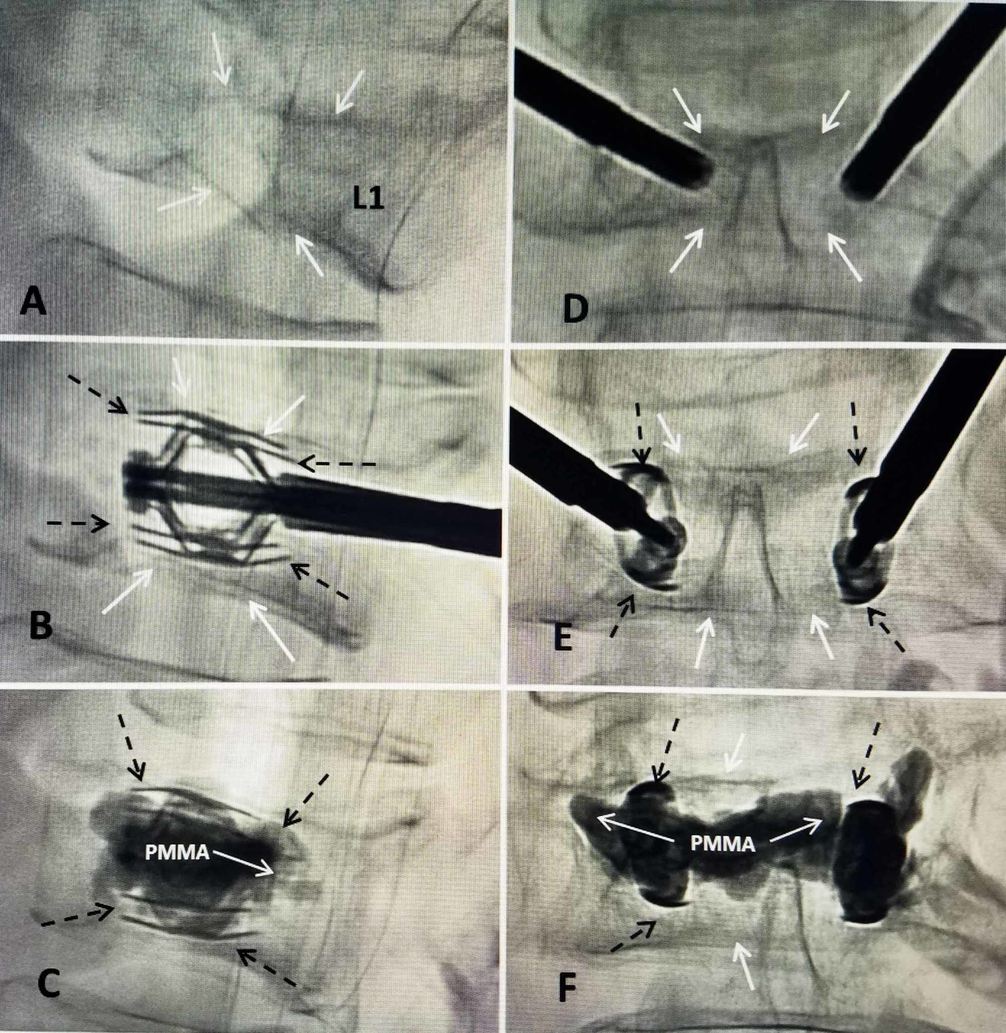 Cureus Treatment of a Highrisk Thoracolumbar Compression Fracture