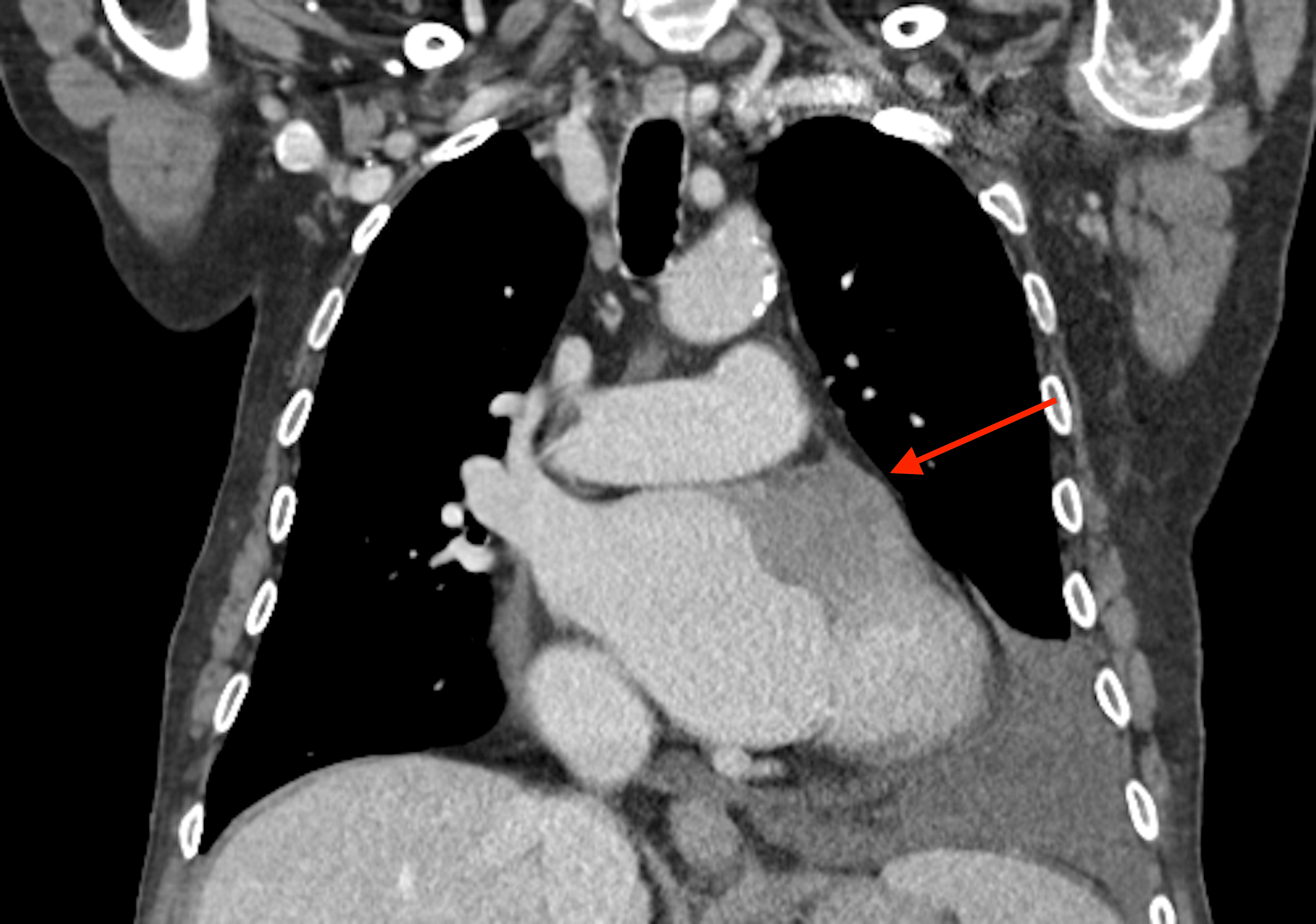 Primary Cardiac Tumor In The Left Atrium A Diagnostic Challenge Cureus 4148