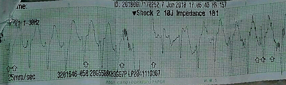 Cureus Congenital Adrenal Hyperplasia Presenting As Pulseless Ventricular Tachycardia In A Neonate