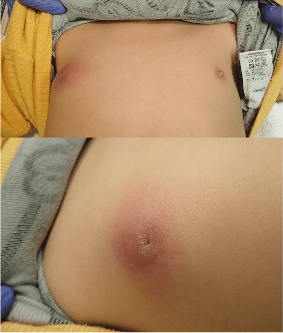 Cureus, A Case of Pediatric Breast Abscess Caused by Rarely Observed  Bacteria in a Three-Year-Old Boy With an Inverted Nipple: Peptoniphilus  harei, Actinotignum sanguinis, and Porphyromonas somerae