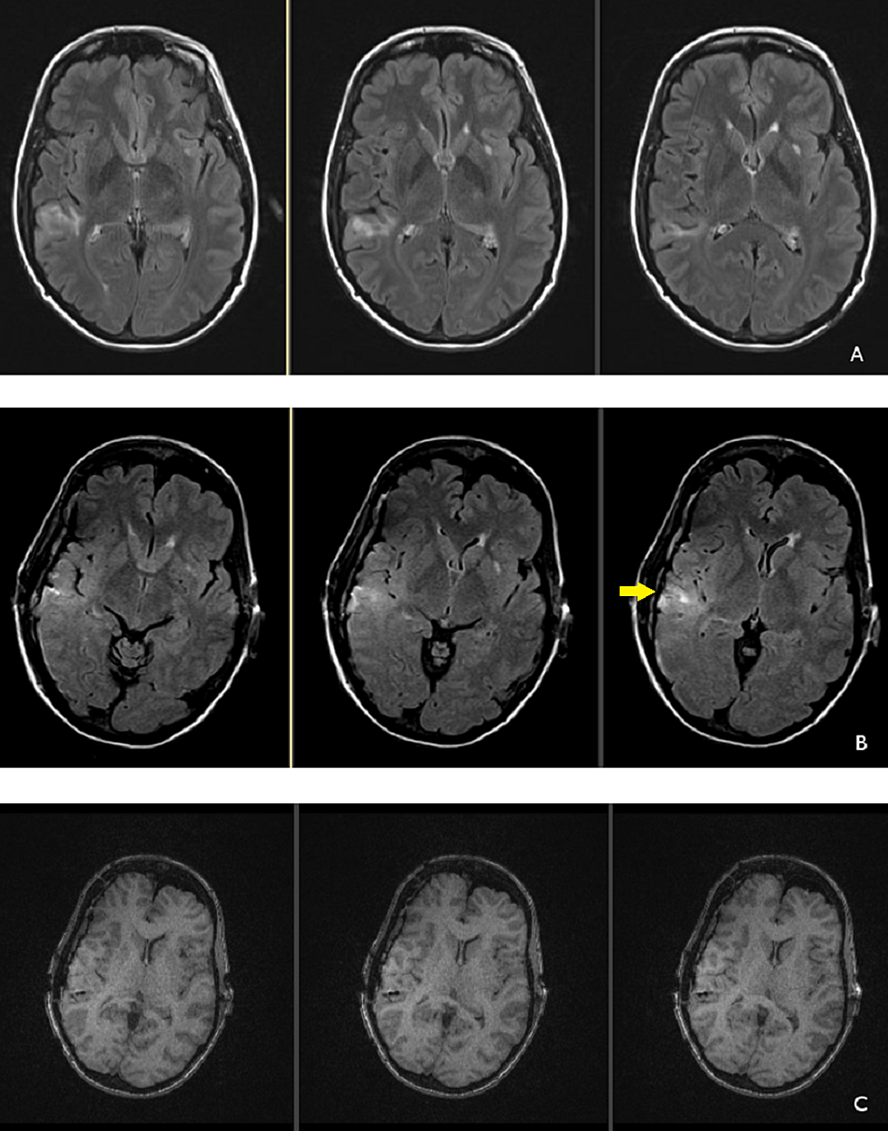 Cureus | Focal Seizures Induced by Intracranial Electroencephalogram Grids