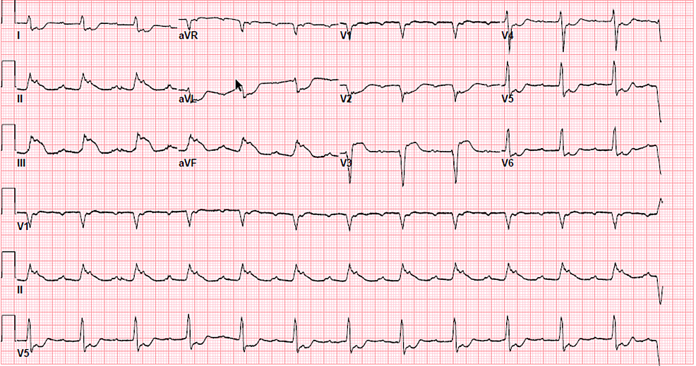 Cureus | A Rare Case of Traumatic Coronary Artery Dissection After a ...