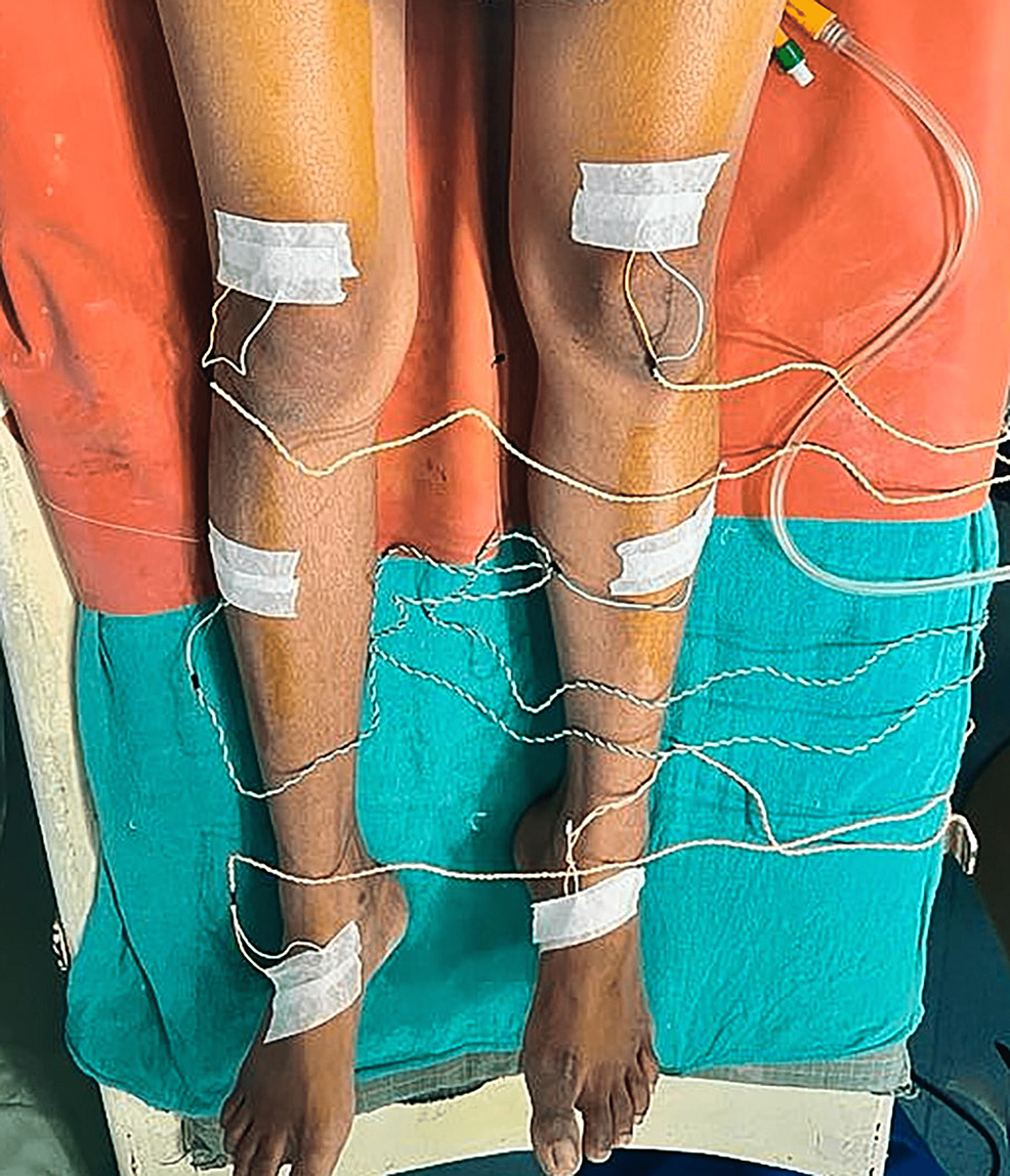 Neuromuscular Monitoring and WakeUp Test During Scoliosis Surgery Cureus