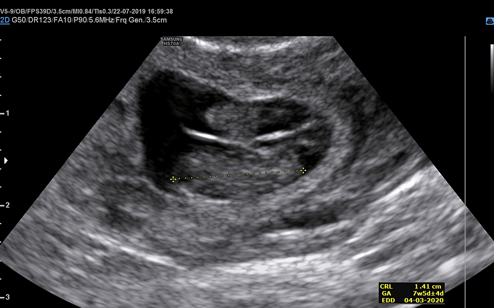 Cureus  Sonographically Positive Fetal Heartbeat in Unilateral