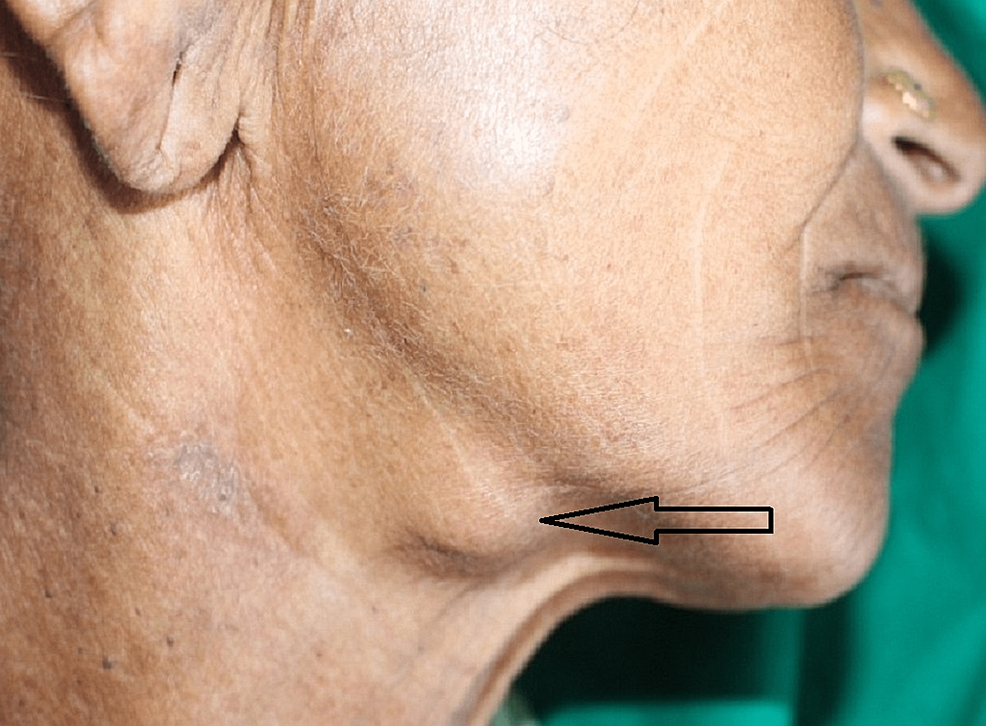 Submandibular Gland Swelling