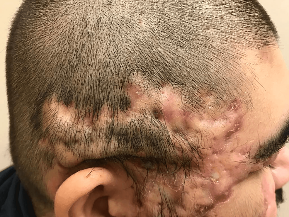 Deeper Seated Than Skin Deep: Report of a Rare Case of Follicular ...